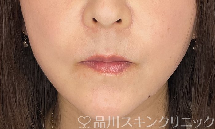 症例NO.74510のBEFORE写真