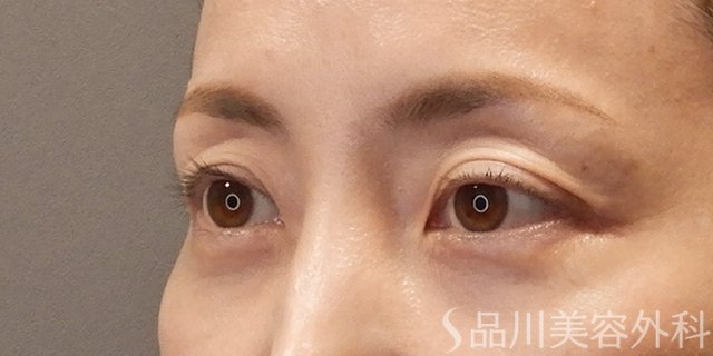 症例NO.74797のBEFORE写真