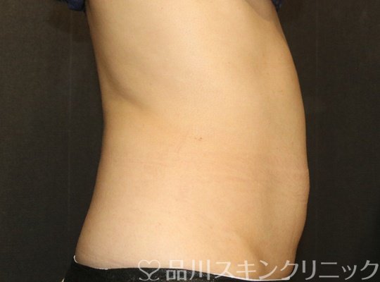 症例NO.71395のAFTER写真