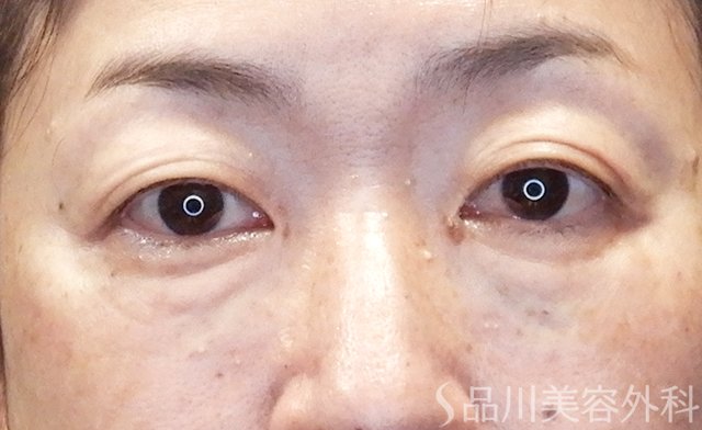 症例NO.65034のAFTER写真