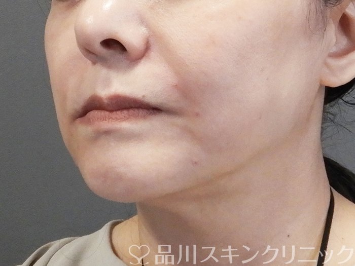症例NO.75179のAFTER写真