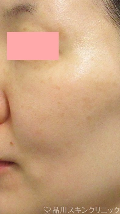 症例NO.72864のAFTER写真