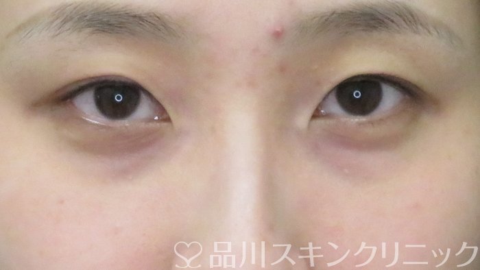 症例NO.72521のBEFORE写真