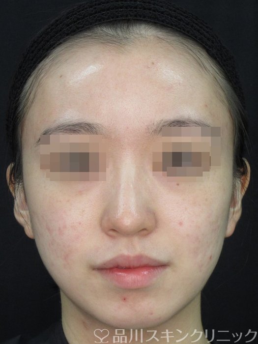 症例NO.72306のAFTER写真