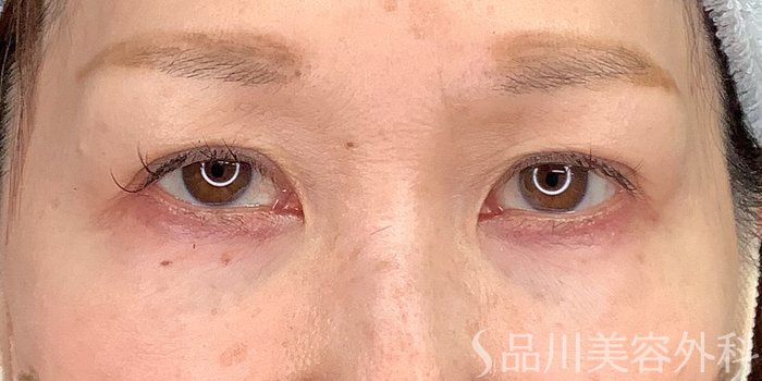 症例NO.71230のAFTER写真