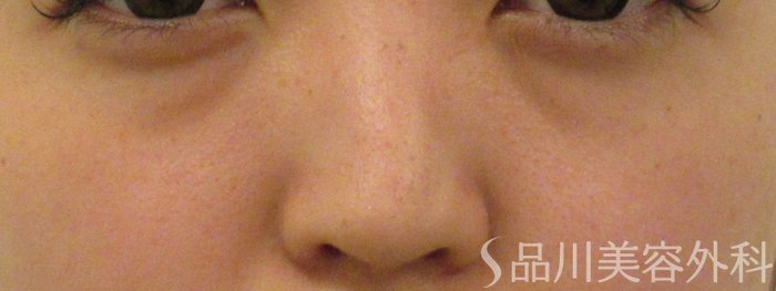 症例NO.70628のBEFORE写真