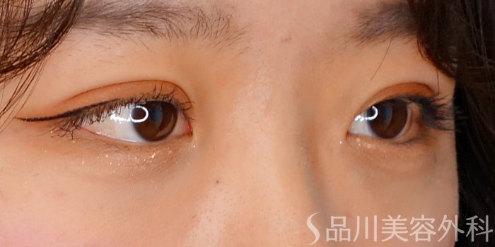 症例NO.69845のAFTER写真