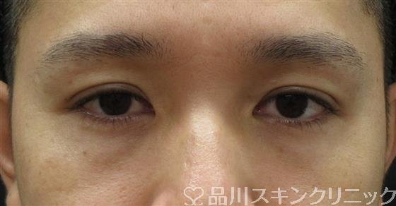 症例NO.61366のBEFORE写真