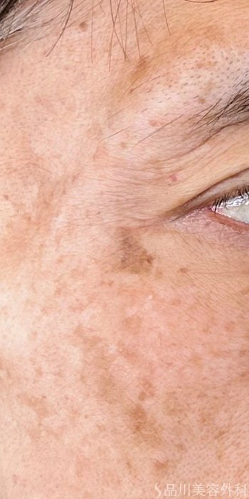 症例NO.72727のBEFORE写真