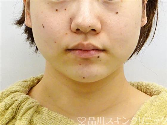症例NO.49601のBEFORE写真