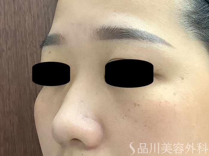 症例NO.63409のBEFORE写真