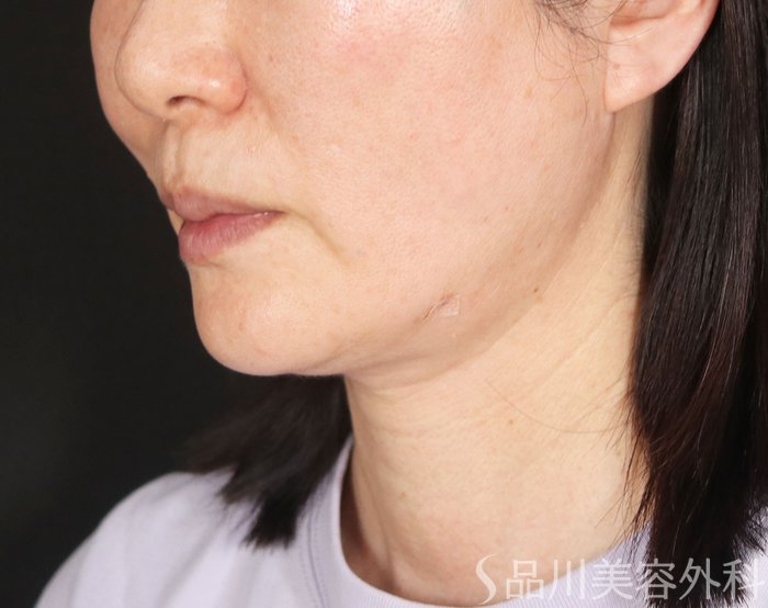 症例NO.73767のAFTER写真