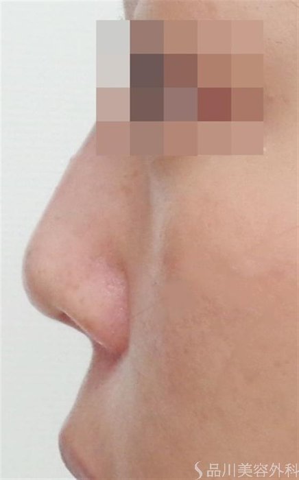 症例NO.47413のAFTER写真