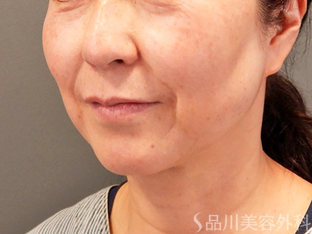 症例NO.70433のBEFORE写真