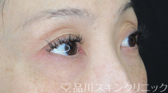 症例NO.69633のBEFORE写真