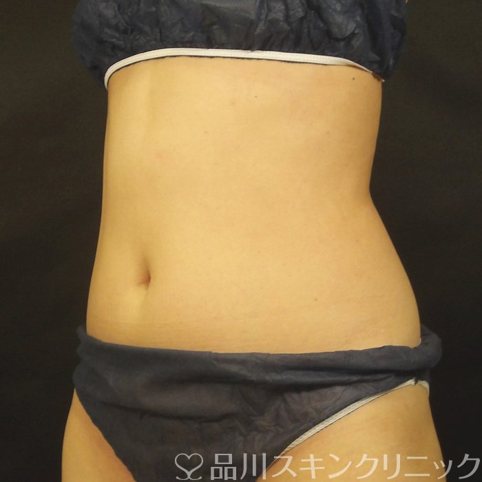 症例NO.67414のAFTER写真