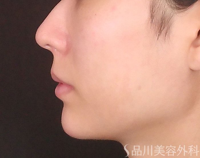 症例NO.71813のAFTER写真