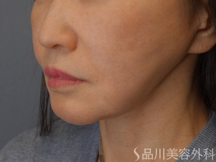 症例NO.74717のBEFORE写真