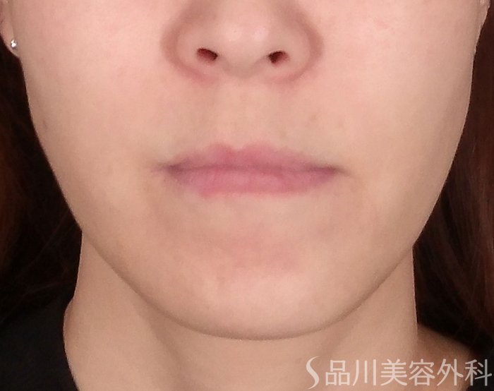 症例NO.69915のBEFORE写真