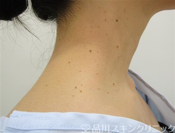 症例NO.41447のBEFORE写真