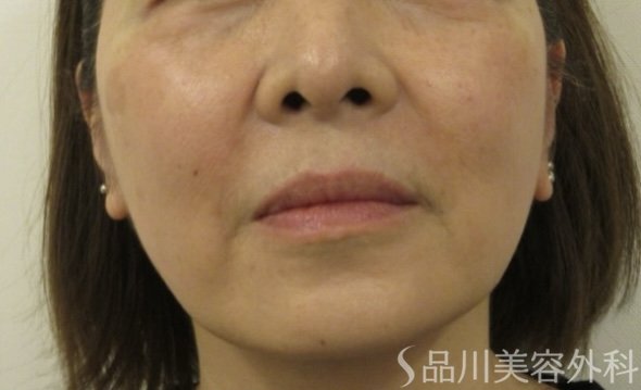 症例NO.72726のAFTER写真