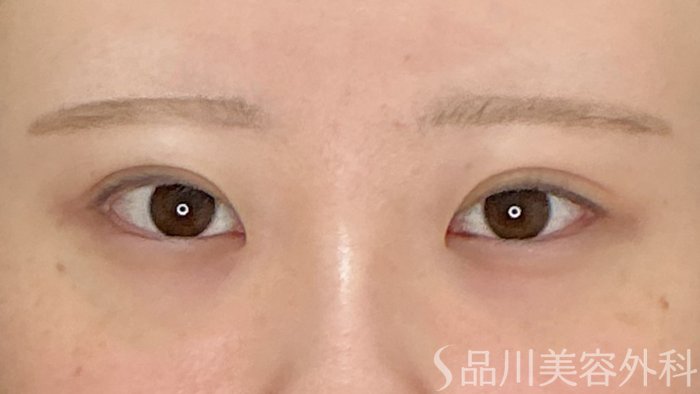 症例NO.71761のAFTER写真