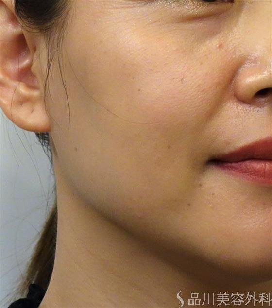 症例NO.37676のBEFORE写真