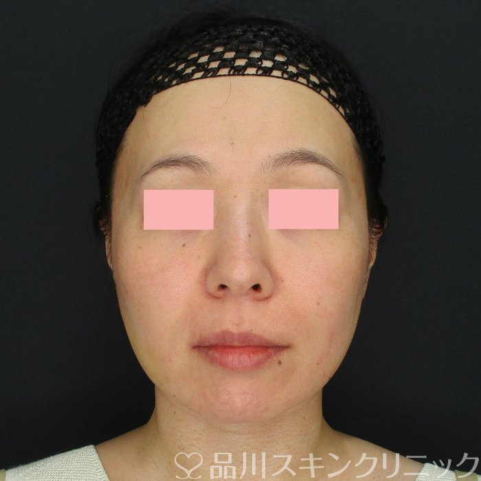 症例NO.71794のAFTER写真