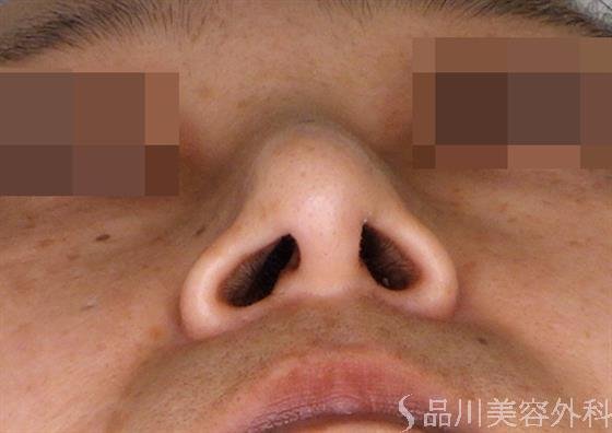 症例NO.47402のAFTER写真