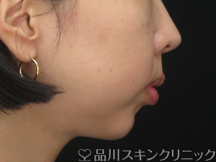 症例NO.69221のBEFORE写真