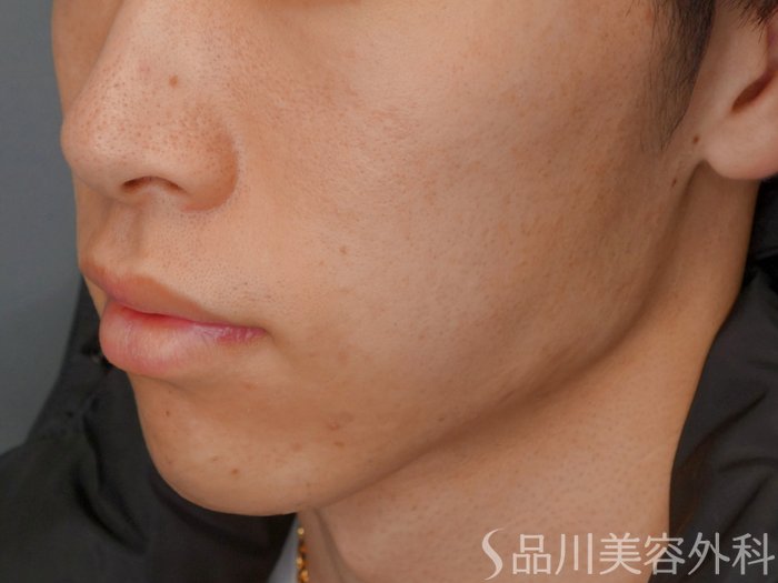 症例NO.73514のAFTER写真