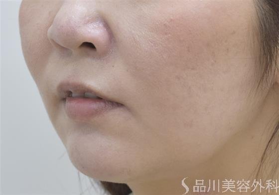 症例NO.46122のBEFORE写真
