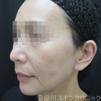 症例NO.71695のAFTER写真