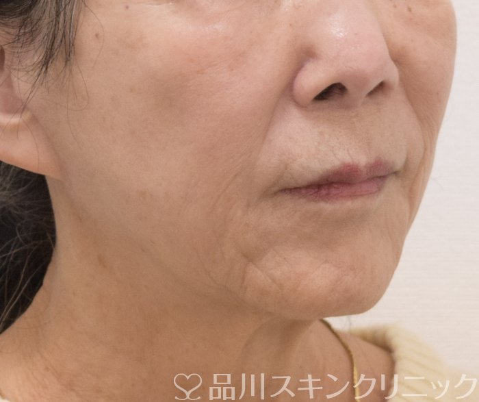 症例NO.73426のAFTER写真