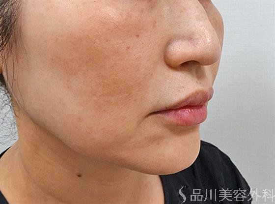 症例NO.61834のBEFORE写真