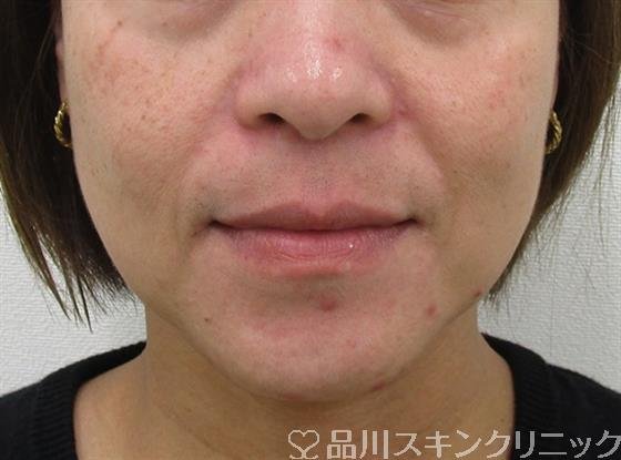 症例NO.49710のBEFORE写真