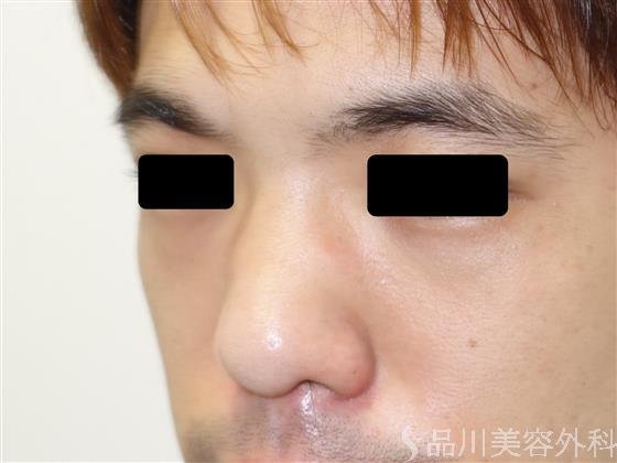 症例NO.43406のBEFORE写真