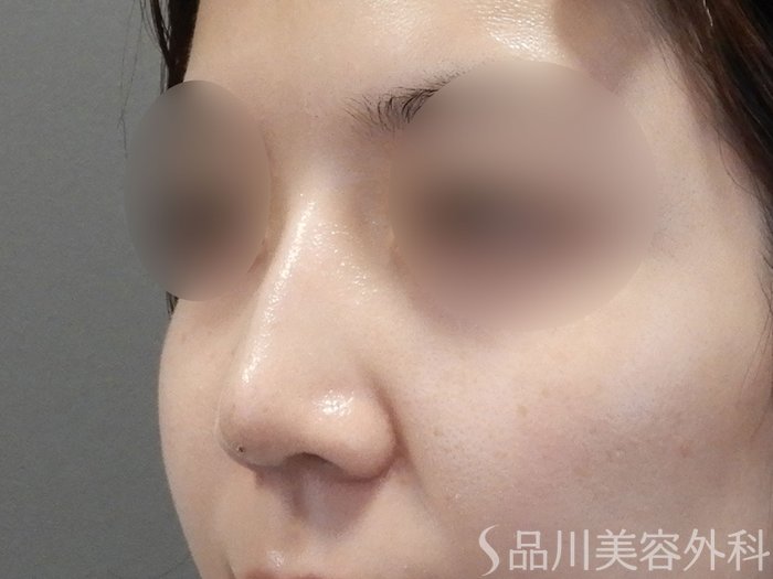 症例NO.72231のAFTER写真