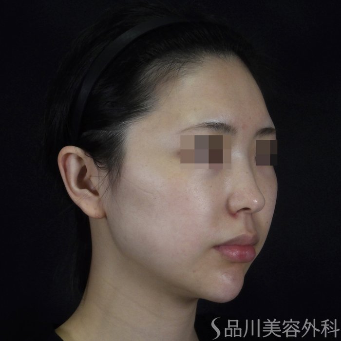 症例NO.70437のBEFORE写真
