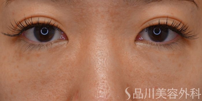 症例NO.62427のBEFORE写真