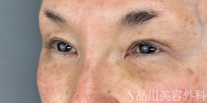 症例NO.72837のAFTER写真