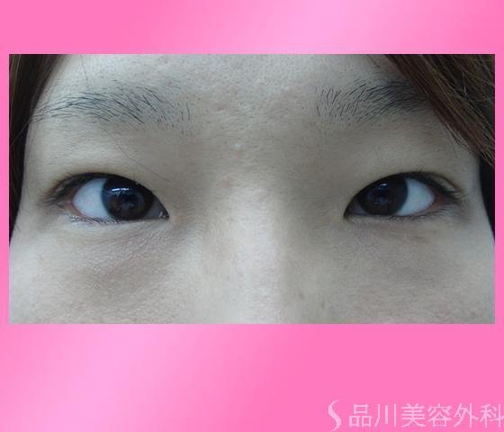 症例NO.3494のBEFORE写真