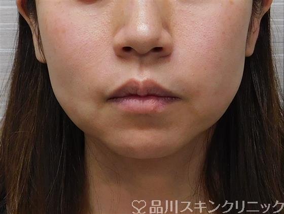 症例NO.48386のBEFORE写真