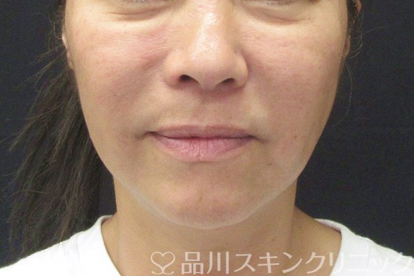 症例NO.65257のBEFORE写真