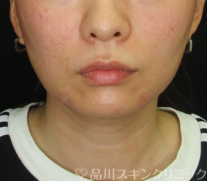 症例NO.72867のAFTER写真