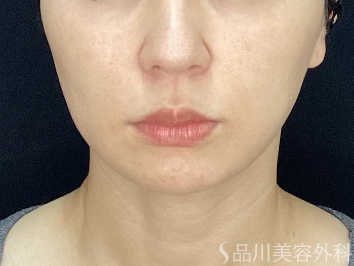 症例NO.72000のBEFORE写真