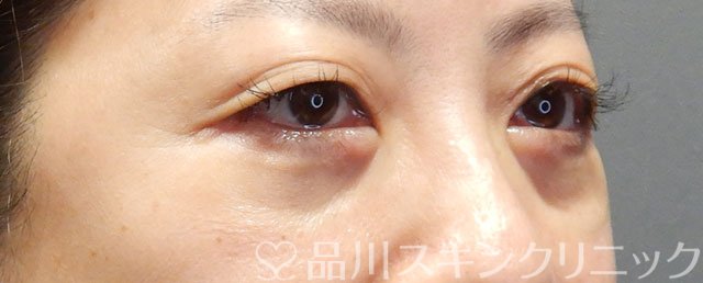 症例NO.72694のAFTER写真