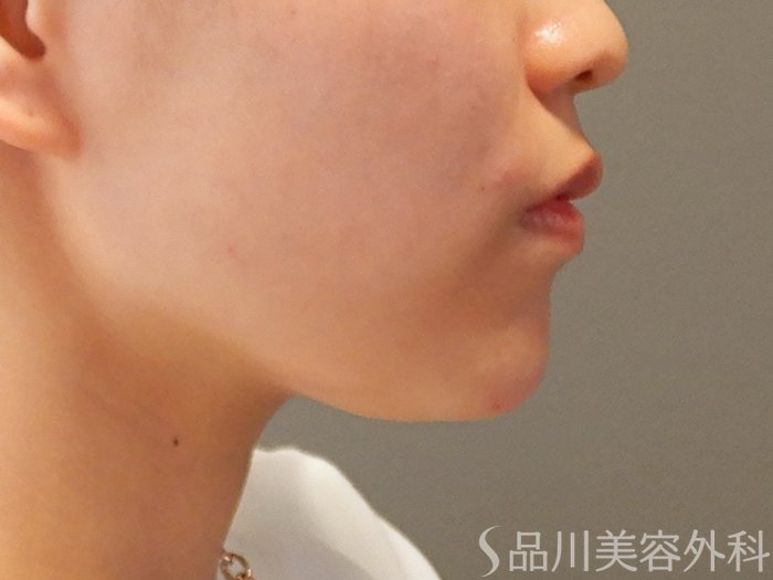 症例NO.70567のAFTER写真