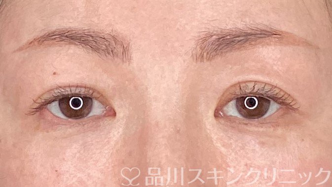 症例NO.64479のAFTER写真