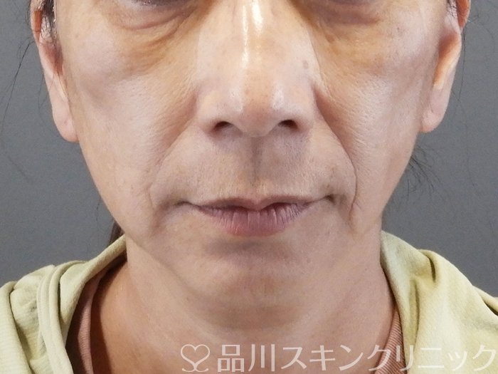 症例NO.65585のBEFORE写真
